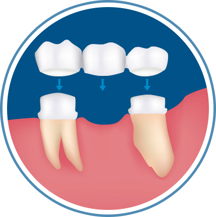 Dental Bridges - Clear Aligners (428x429)
