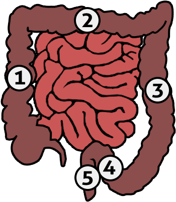 Human Colon - Types Of Bowel Diversions (376x418)