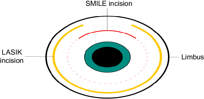 Schematic Representation Of Smile Incision And Lasik - Circle (694x337)