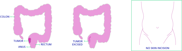 Local Excision Diagram For Tamis Surgery - Illustration (800x230)
