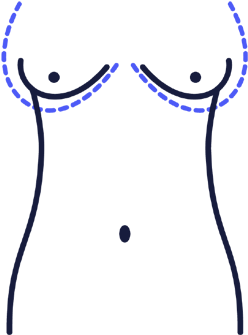 Breast Augmentation - Breast Augmentation (400x400)