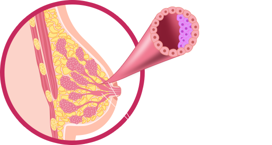 An Estimated 1 In 5 New Cases Of Breast Cancer Are - Basic Pump (545x290)