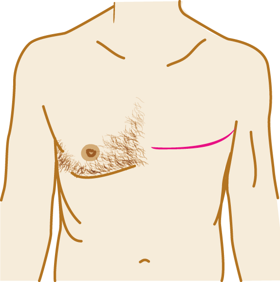 It Involves Removing All The Breast Tissue Including - Lymph Nodes Male Breast (575x578)