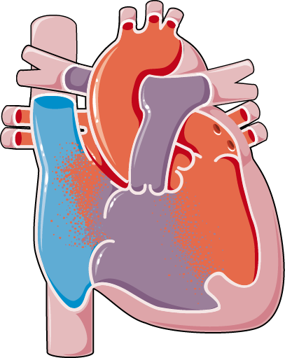 Congenital Heart Diseases Atrioventricular Canal Defect - Birth Defect (407x511)