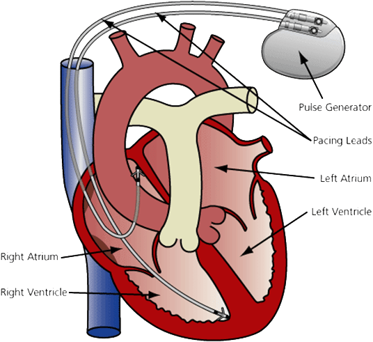 Rate Clipart Triple Heart - Pacemaker In The Heart (590x514)