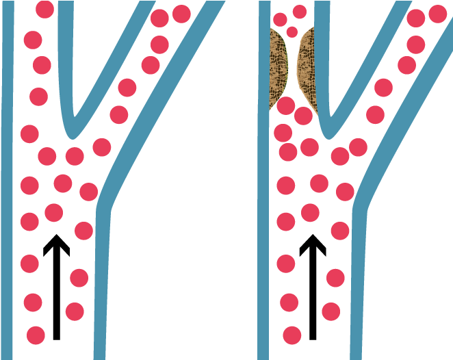 Illustration Of Carotid Artery Disease - Artery (700x525)