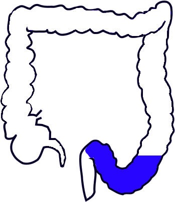 Sigmoid Colon - Sigmoid Colon (376x418)