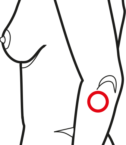 Epicondylitis - Tennis Elbow (418x478)