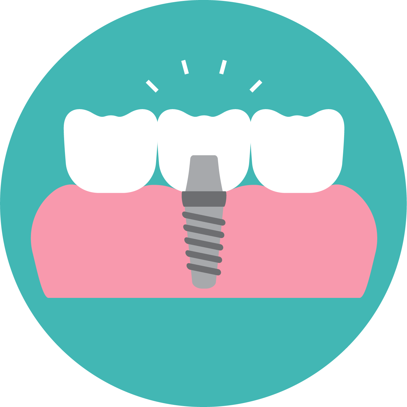 Implant Dentistry - East Melbourne (1340x1339)