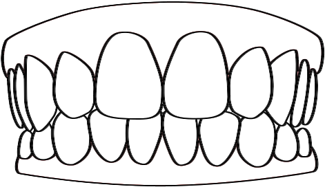 Dentures At Middlesex Cosmetic Dentistry Massachusetts - Tooth (556x414)