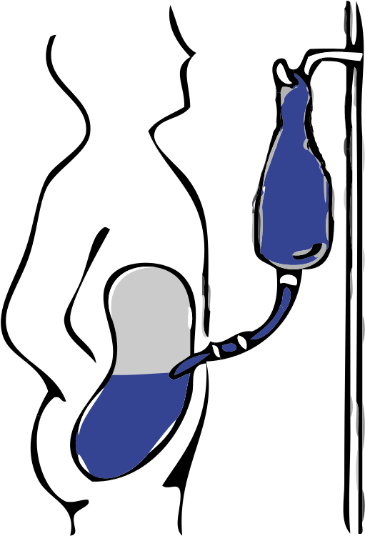 File - Dp Infusion - Svg - Happens When Your Kidneys Fail (706x768)