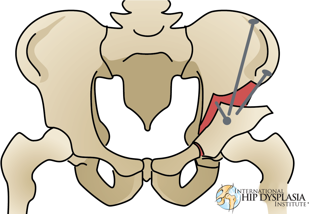 [ ] Enlarge - Triple Pelvic Osteotomy Human (1313x869)