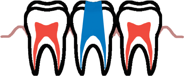 When Tooth Decay Reaches The Dental Pulp, Root Canal - When Tooth Decay Reaches The Dental Pulp, Root Canal (960x381)