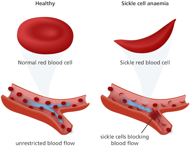 The Sickle Blood Cells Burst More Quickly Than Others - Sickle Cell Anemia Red Blood Cells (695x543)