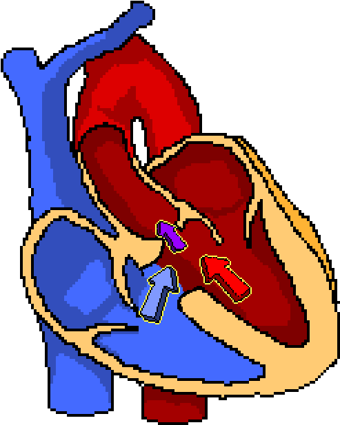 Ventricular Septal Defect (648x734)