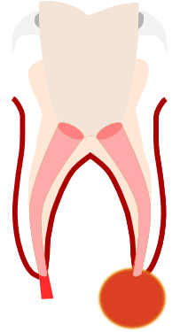 Preparation Of The Root Canals - Illustration (500x626)