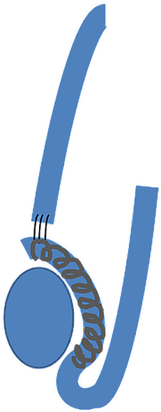 An Vasoepididymostomy Is Performed, With Return Of - An Vasoepididymostomy Is Performed, With Return Of (261x600)