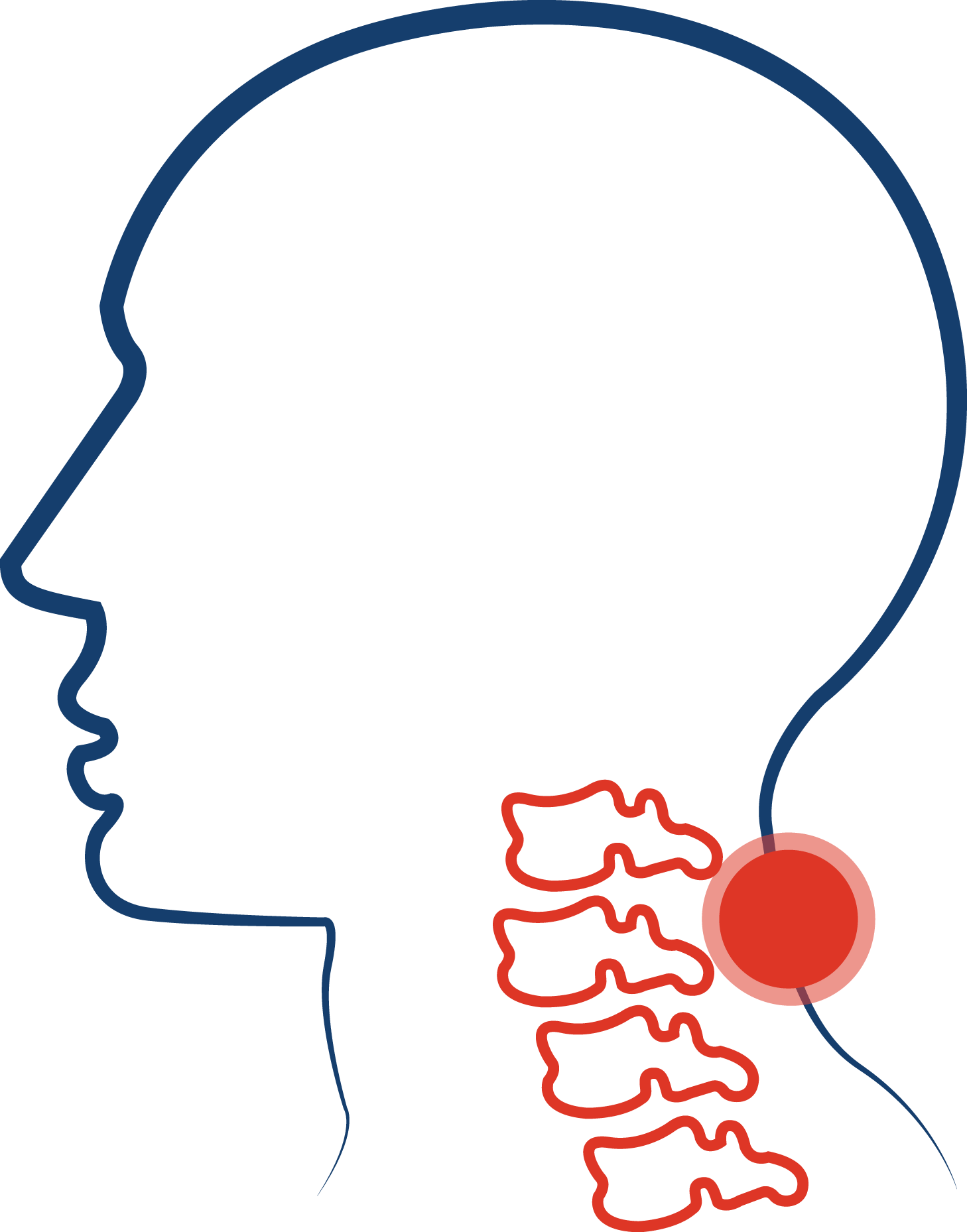 Cervical Spinal Stenosis - Cervical Spinal Stenosis (1458x1858)