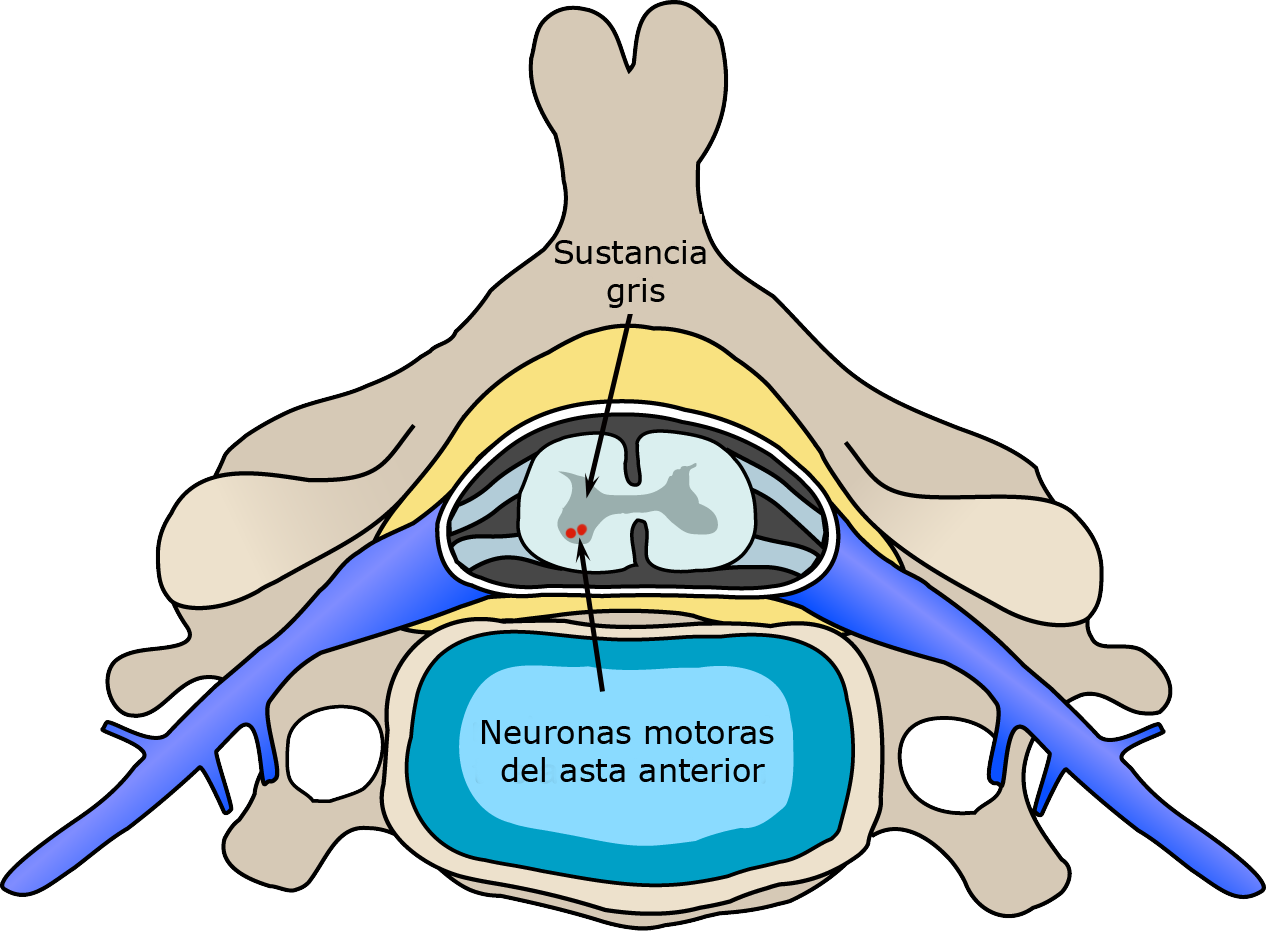 Polio Spinal Diagram Es - Polio Effect On Spinal Cord (1266x931)