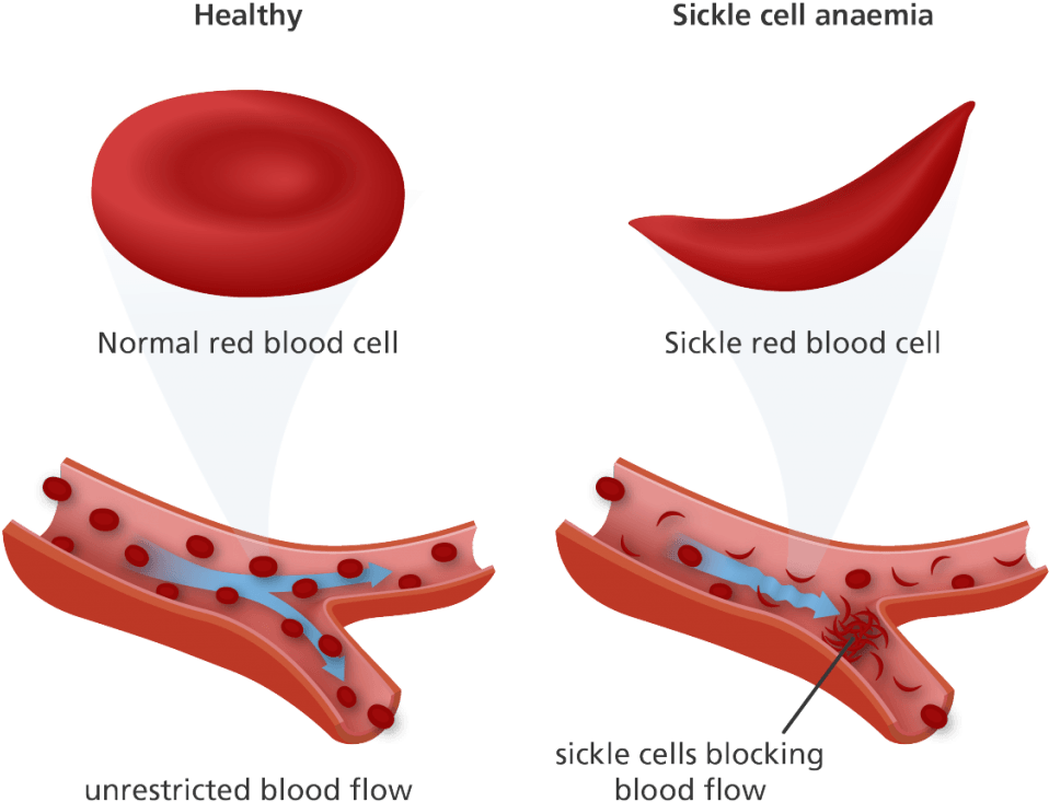 Multiple Myeloma Drug Could Revolutionize Treatment - Normal Red Blood Cell And Sickle Cell (1024x800)