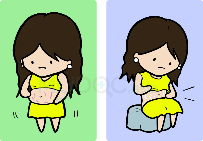 Changes To Your Body After Giving - Stretch Marks Pregnancy Cartoon (800x559)