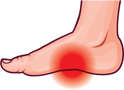 Arch Pain - Clip Art Foot Pain (600x600)