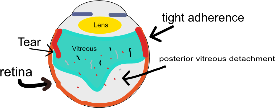 In Fact, It Really Cannot Let Go Of The Retina Beyond - Vitreous Body (993x450)