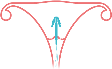 How To Use It - Female Sterilisation (619x413)