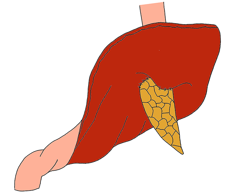 Outer Layer Is Performed Between The Pancreatic Capsule - Illustration (800x800)