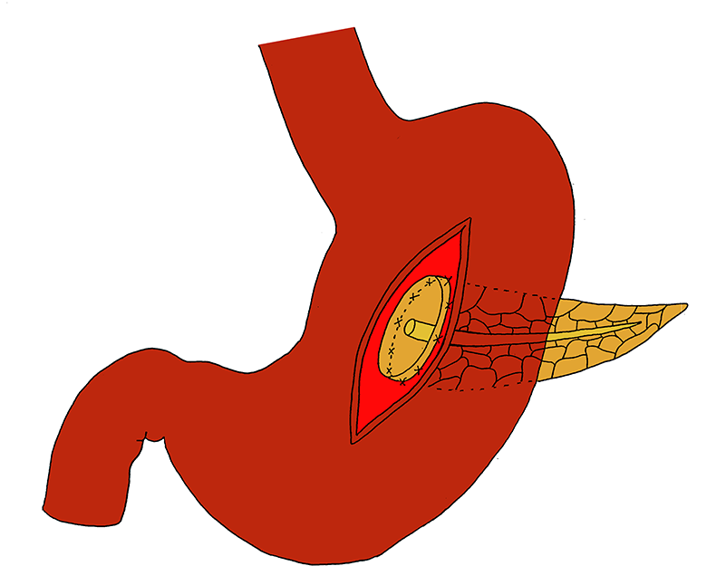 The Anterior Incision Is Closed Or The Clamp Is Replaced - Pancreas (800x800)
