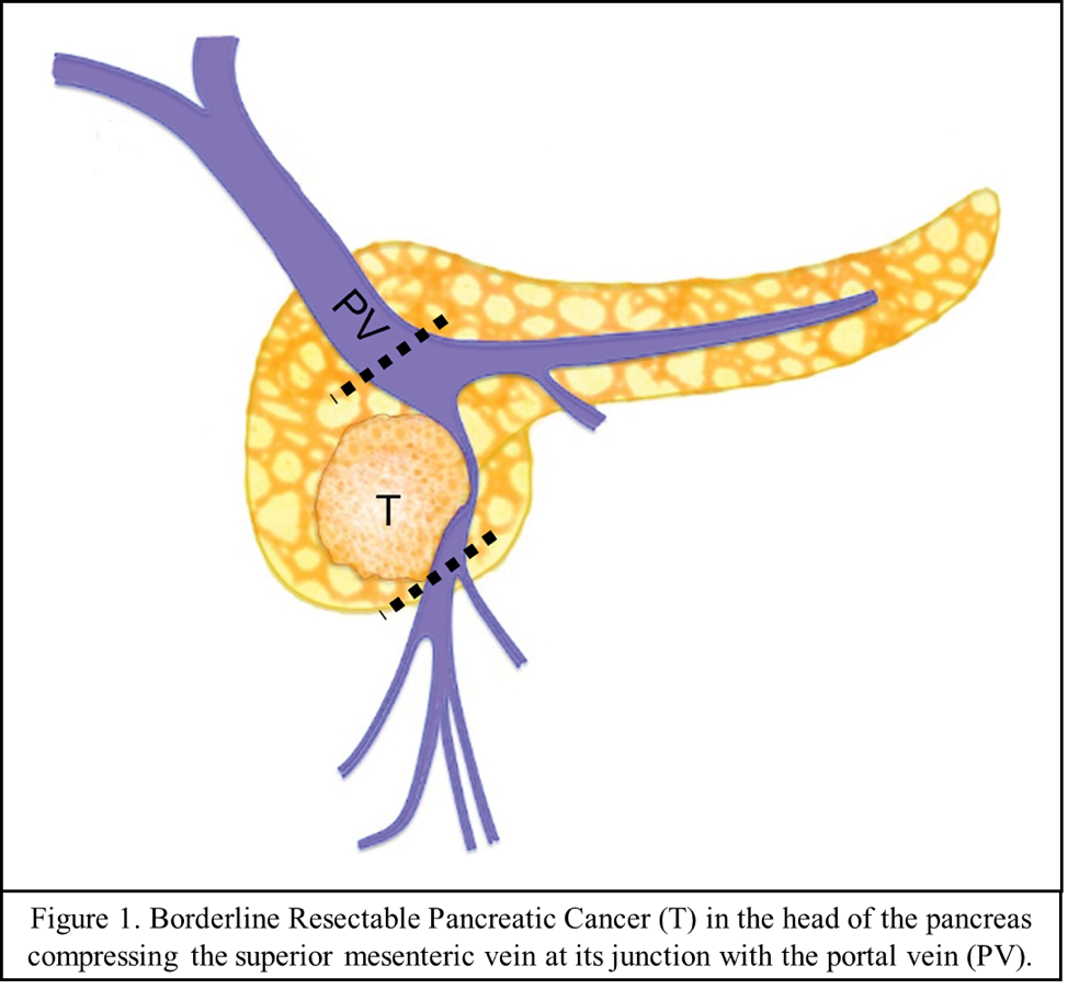 Outcome Of Patients With Borderline Resectable Pancreatic - Outcome Of Patients With Borderline Resectable Pancreatic (974x902)