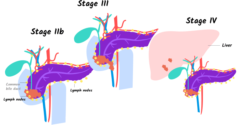 Illustration Of Stages Iib, Iii, And Iv Of Pancreatic - 4 Pancreatic Cancer Stages That Help You (778x400)