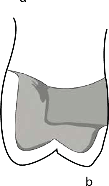 Coping Design For A Metal-ceramic Restoration With - Ceramic (497x631)