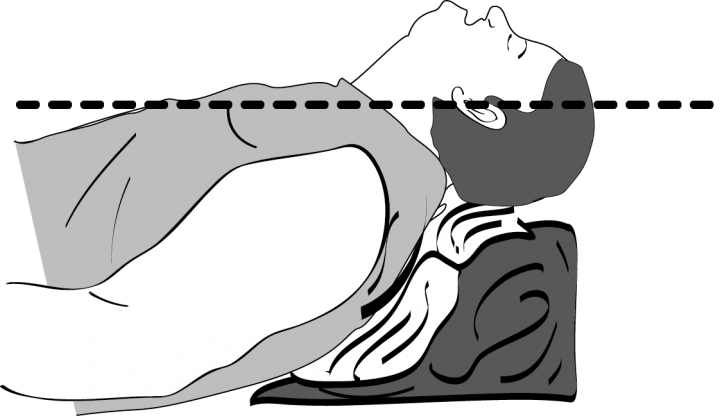 Head Up Intubation - Airway Positioning (720x416)