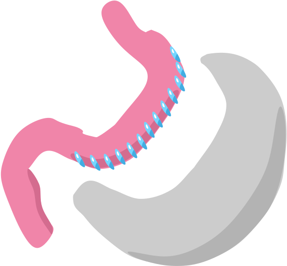 Complications - تكميم المعده (665x669)