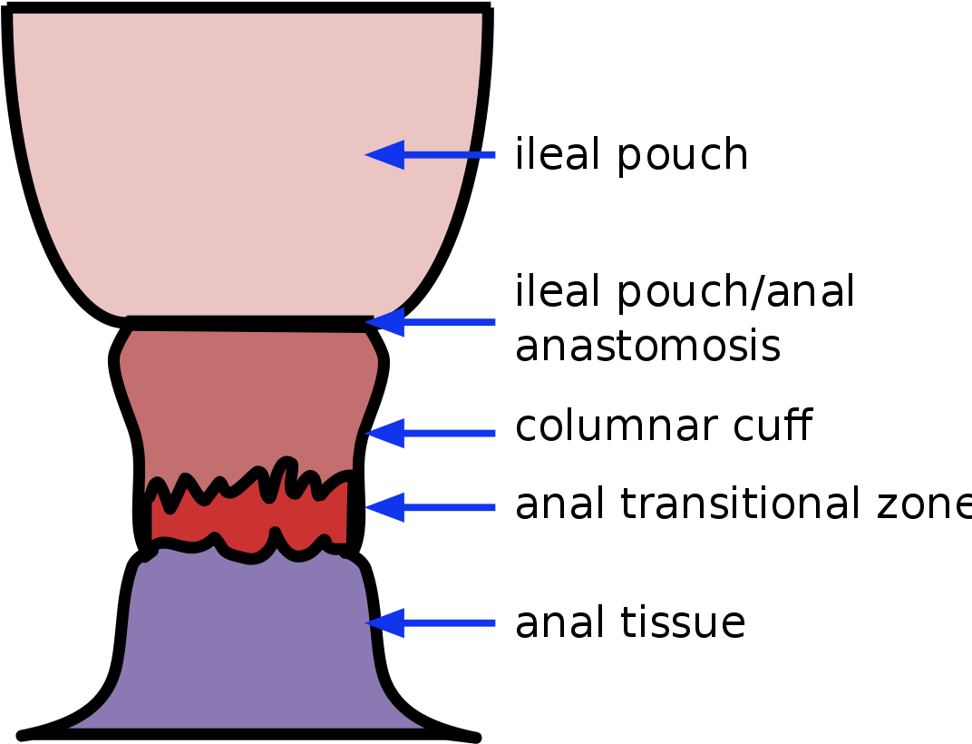 Ileoanal Anastomosis Rectal Cuff (1200x856)