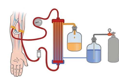 Operating On Patients On Dialysis What Are The Anaesthetic - Illustration (600x380)