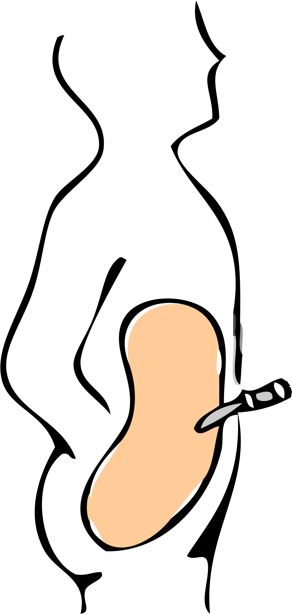 Open - Peritoneal Dialysis Transparent (2000x2175)