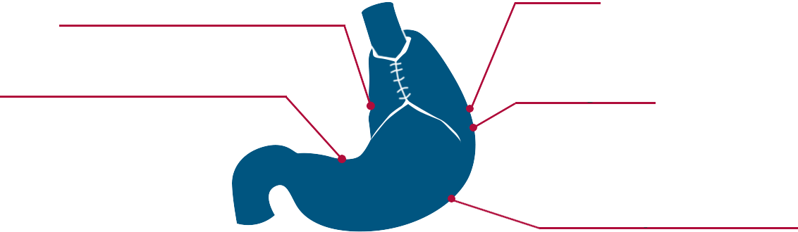 Gerd Gastroenterology Marina Del Rey Hospital Laparoscopic - Diagram (1132x330)