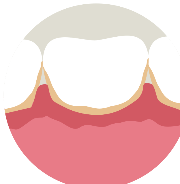 Illustration Of Swollen, Bleeding Gums - Bleeding On Probing (1018x840)