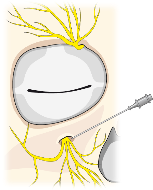 The Lower Margin Of The Orbita Is Located, And Subsequently - Maastricht (489x615)