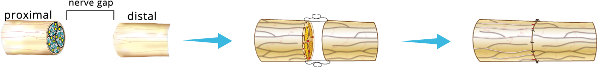 A Direct Repair May Be Done When There Is No Gap Between - Illustration (1280x191)