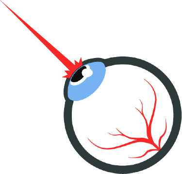 Lasik Surgery - Lasik Surgery Clipart Png (375x375)