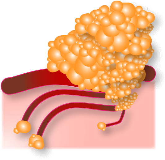 At This Advanced Stage, Tumors Have Spread To Multiple - Illustration (564x543)