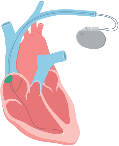 The Electrical Impulses Can Be Disrupted In Heart Muscle - Artificial Cardiac Pacemaker (464x571)
