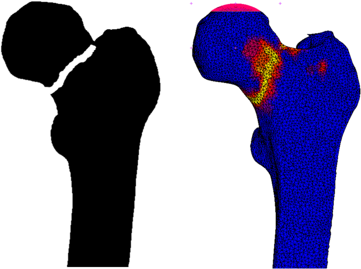 Example Of Femoral Fracture Prediction - Radboud University Medical Center (783x549)