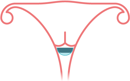The Diaphragm Will Stop Sperm From Reaching An Egg - Thong (619x413)