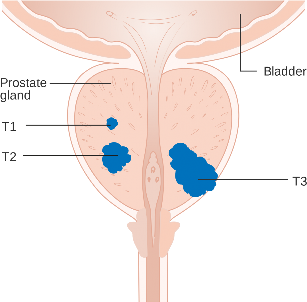 Prostate Cancer Affects Almost A Quarter Of A Million - Prostate (1170x1164)