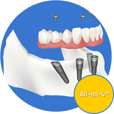 Custom Dental Offers A Variety Of Dental Implant Options - All-on-4 (400x400)
