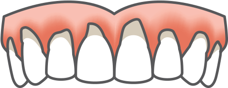 Supplemental Dental Implant Treatment Icon - Non Prep Veneers Nürnberg (470x313)